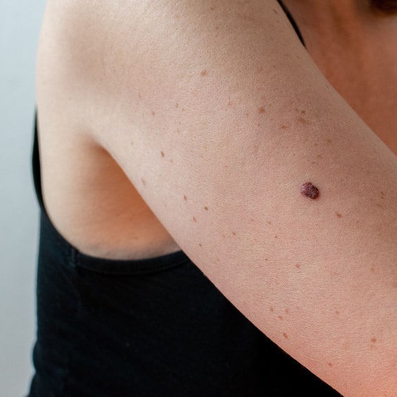 3 Types of Skin Cancer That Should Be on Everyone’s Radar