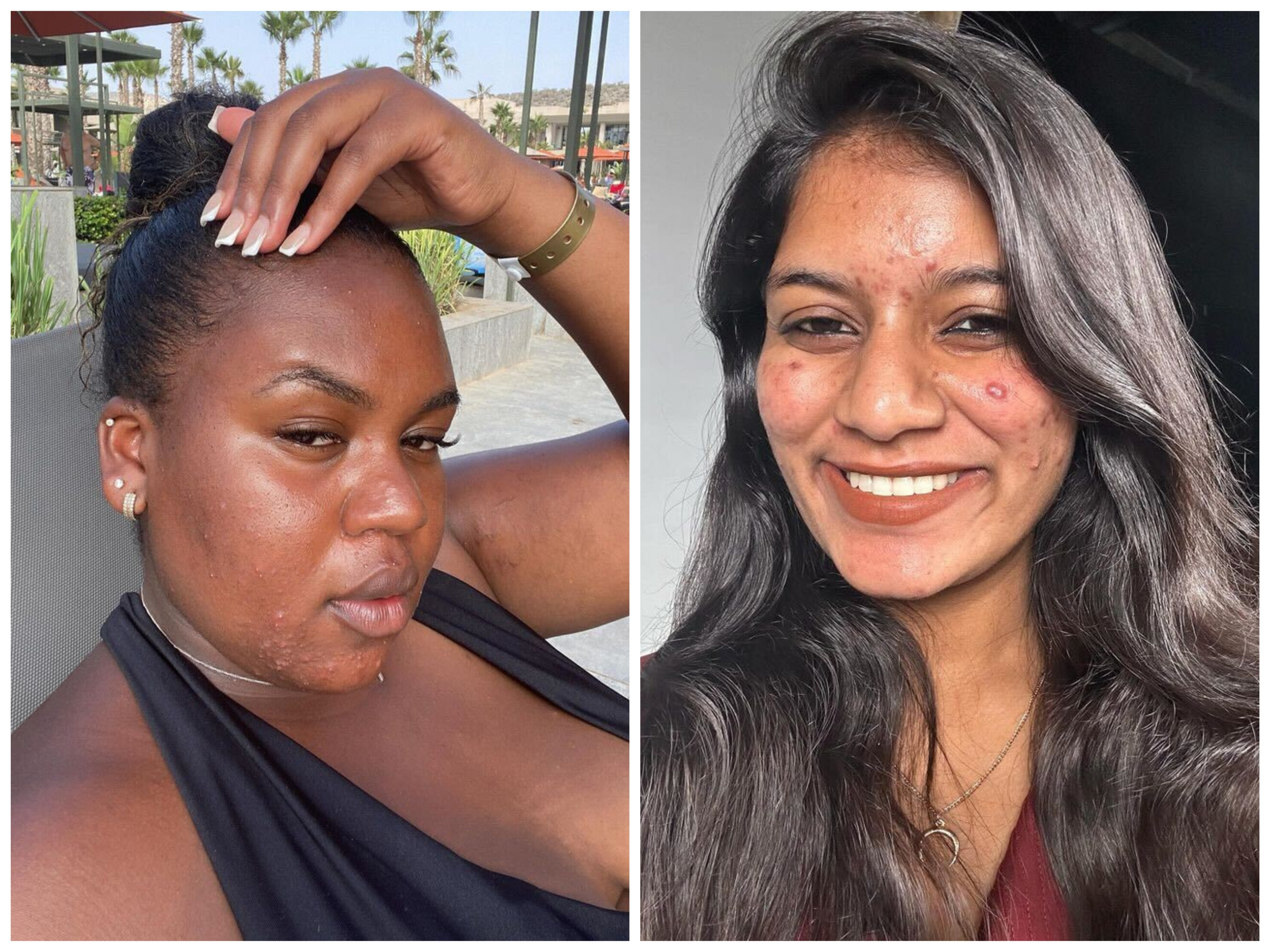 Just 12 People Proudly Sharing Unfiltered, Makeup-Free Pics of Their Acne