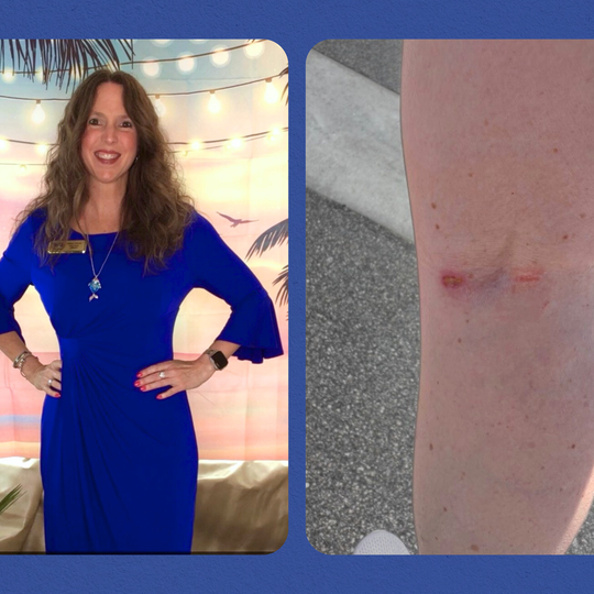 I’ve Had One Bad Sunburn in My Life&-And So Many Skin Cancers I’ve Lost Count